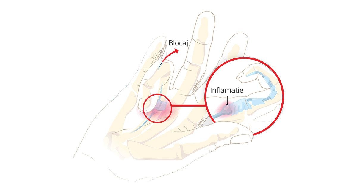 articulație pe degetul inelar inflamat