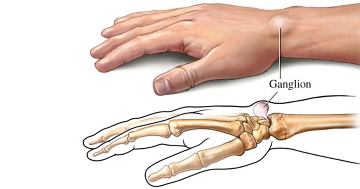 Chist sinovial articular